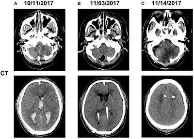 Multidrug Resistant Brain Abscess Due to Acinetobacter baumannii Ventriculitis Cleared by Intraventricular and Intravenous Tigecycline Therapy: A Case Report and Review of Literature
